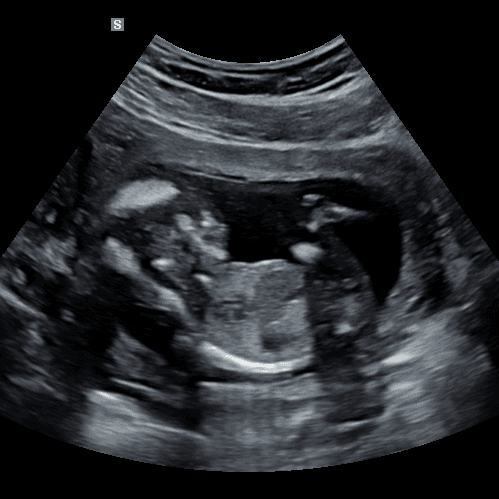 2D ultrasound scan