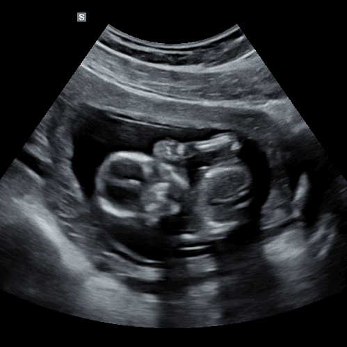 2D ultrasound face