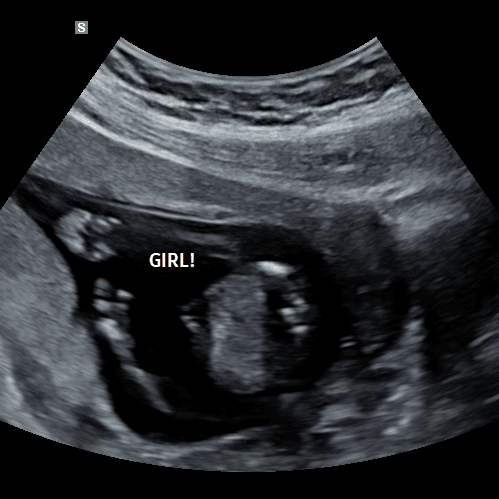 Gender reveal ultrasound