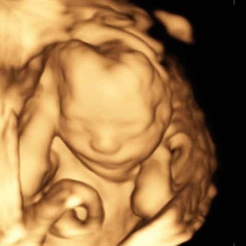 3D ultrasound baby