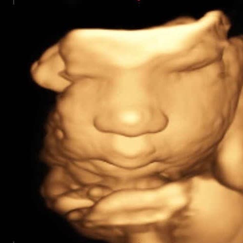 3D ultrasound baby face