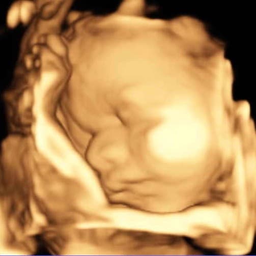 3D ultrasound profile